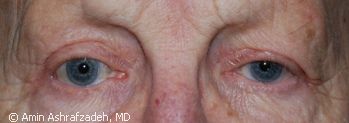 Image of patient after eyelid surgery, blepharoplasty